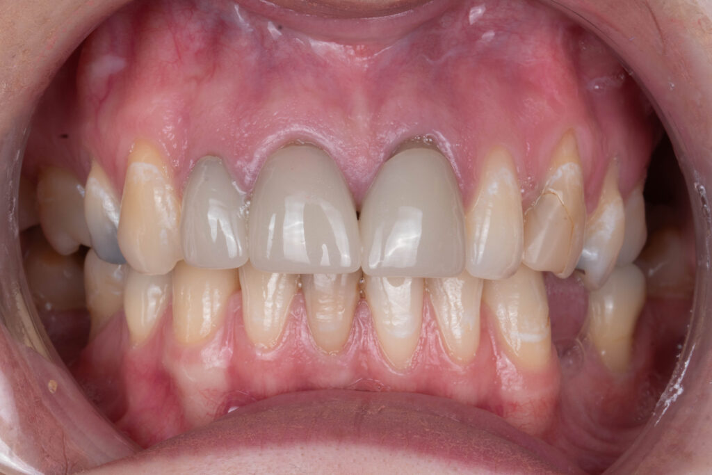 Dental Veneers