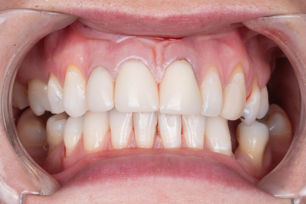 Dental Veneers