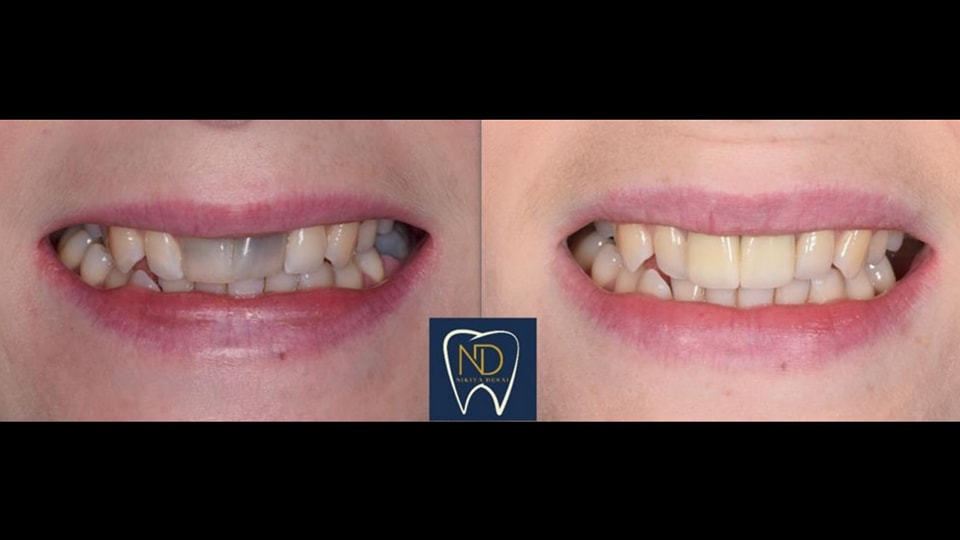 Discolured teeth