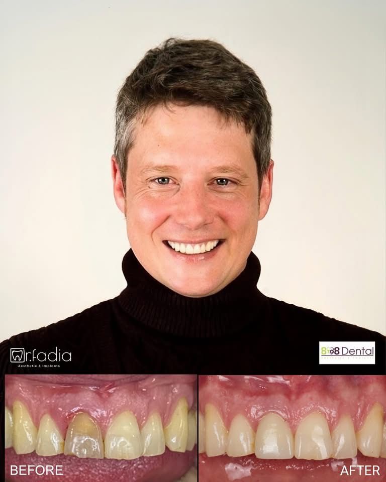 Single Tooth Implants