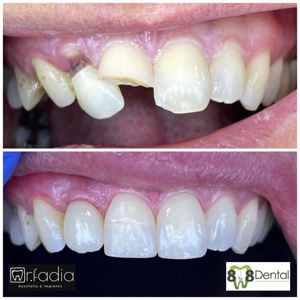 Single Tooth Implants