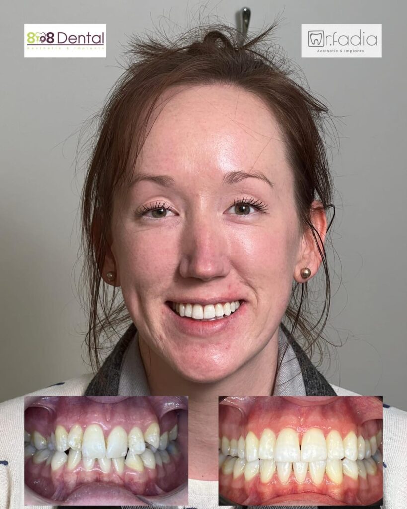Teeth Straightening