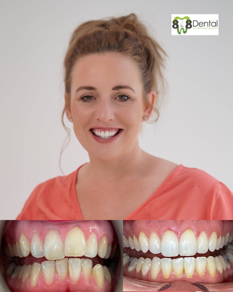 Teeth Straightening
