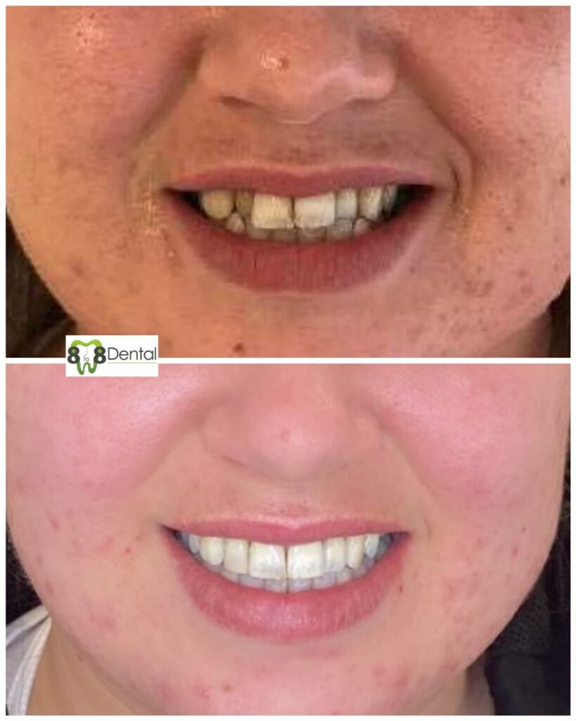 Teeth Straightening