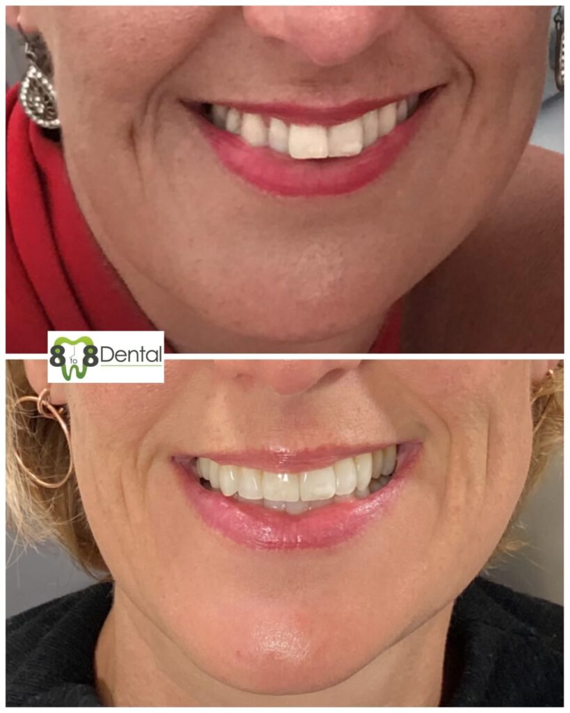 Teeth Straightening