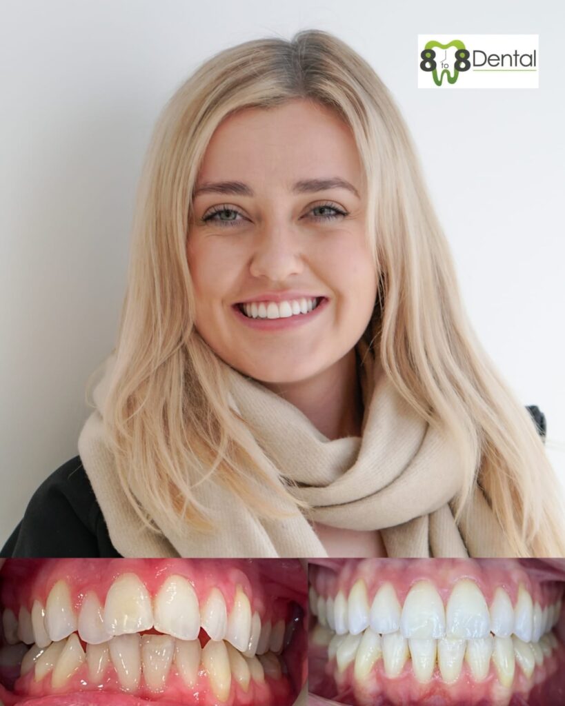 Teeth Straightening