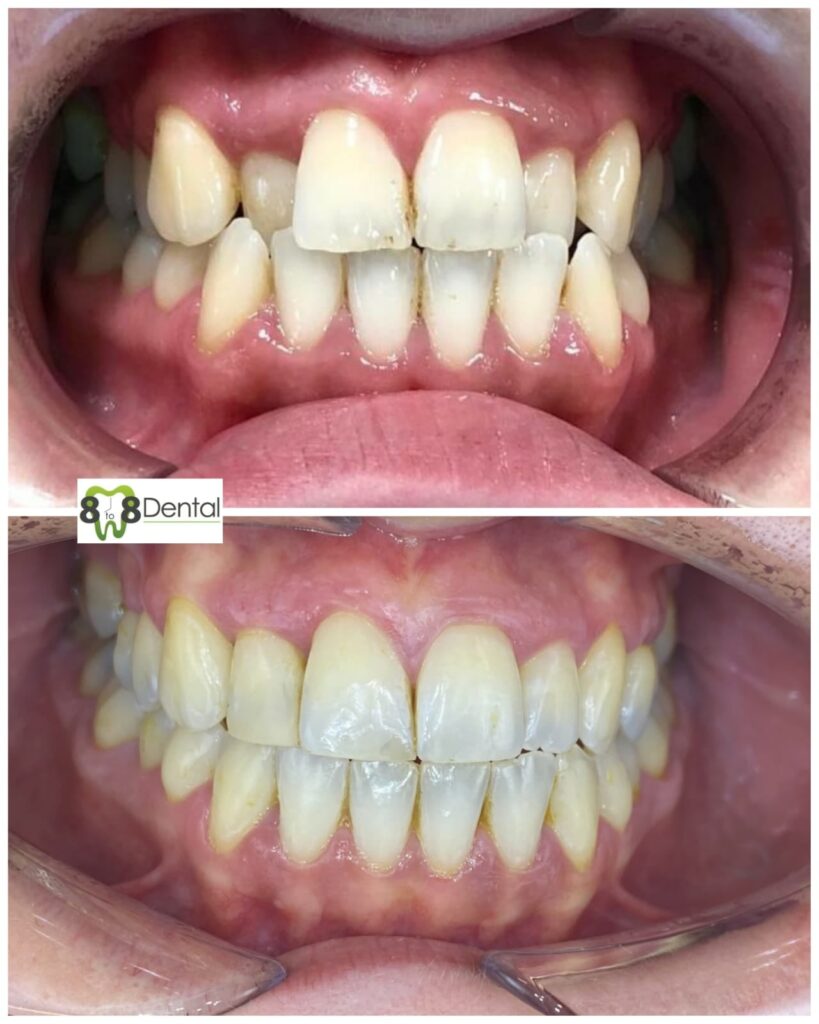 Teeth Straightening