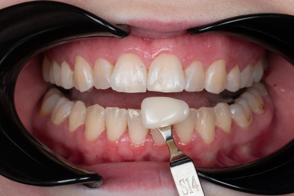 whitening