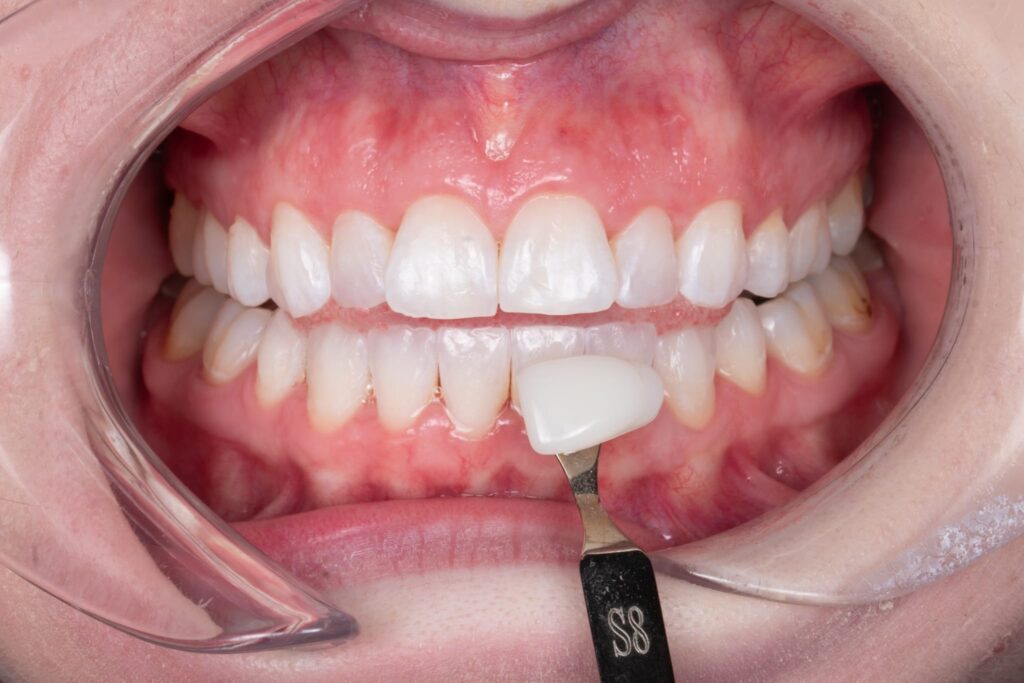 whitening